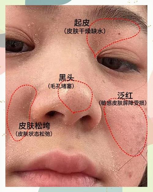 脸上干燥脱皮怎么解决缩略图