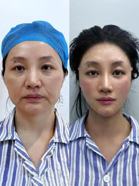 整脸型的大概费用是多少钱缩略图