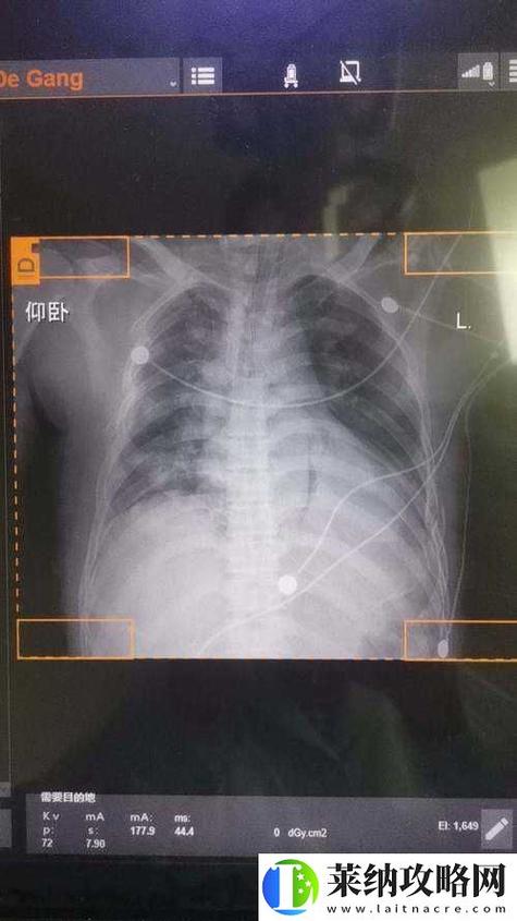 100胸片曝光率免费无病毒