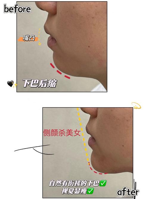 假下巴和真下巴的区别图标